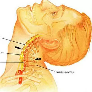Лечение Шейной остеохондроз.