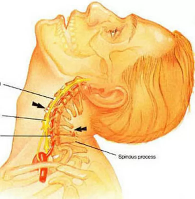 Лечение Шейной остеохондроз.